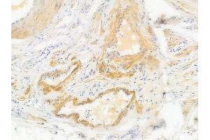 ABIN6256659 and ABIN6267529 at 1/100 staining human testicular cancer by IHC-P. (JNK Antikörper  (pTyr185))