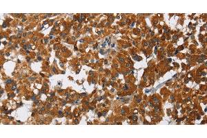 Immunohistochemistry of paraffin-embedded Human thyroid cancer using CAT Polyclonal Antibody at dilution of 1:40 (Catalase Antikörper)