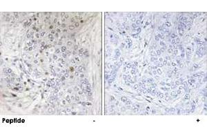 Immunohistochemistry analysis of paraffin-embedded human breast carcinoma tissue, using MAFF polyclonal antibody . (MafF Antikörper)