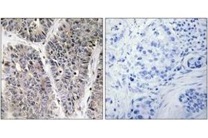 Immunohistochemistry analysis of paraffin-embedded human lung carcinoma tissue, using NBL1 Antibody.