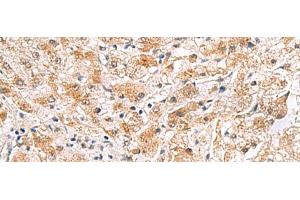Immunohistochemistry of paraffin-embedded Human liver cancer tissue using PDCL2 Polyclonal Antibody at dilution of 1:65(x200) (PDCL2 Antikörper)