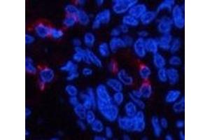 Immunofluorescence analysis of Human lung cancer tissue using LTF Monoclonal Antibody at dilution of 1:200. (Lactoferrin Antikörper)