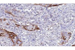 ABIN6273628 at 1/100 staining Human urothelial cancer tissue by IHC-P. (FGFBP1 Antikörper  (C-Term))
