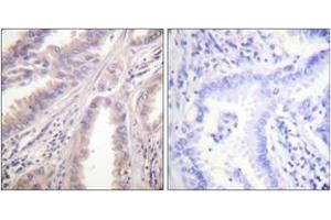 Immunohistochemistry analysis of paraffin-embedded human lung carcinoma tissue, using KIF11/Eg5 (Ab-927) Antibody.
