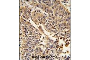 Formalin-fixed and paraffin-embedded human lung carcinoma reacted with JUP Antibody (C-term), which was peroxidase-conjugated to the secondary antibody, followed by DAB staining. (JUP Antikörper  (C-Term))