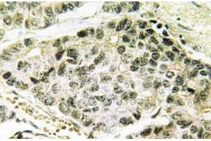 Immunohistochemistry (IHC) analyzes of p-SNAI 1 antibody in paraffin-embedded human lung carcinoma tissue. (SNAIL Antikörper  (pSer246))