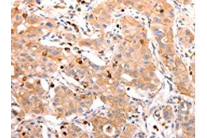 The image on the left is immunohistochemistry of paraffin-embedded Human lung cancer tissue using ABIN7190209(CELSR2 Antibody) at dilution 1/50, on the right is treated with synthetic peptide. (CELSR2 Antikörper)