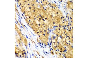 Immunohistochemistry of paraffin-embedded human lung cancer using CAPG Antibody. (CAPG Antikörper)