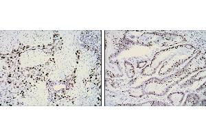 Immunohistochemical analysis of paraffin-embedded lung cancer (left) and rectal cancer (right) using KI67 mouse mAb with DAB staining. (Ki-67 Antikörper)