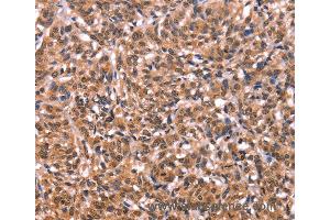 Immunohistochemistry of Human liver cancer using ESRRB Polyclonal Antibody at dilution of 1:40 (ESRRB Antikörper)
