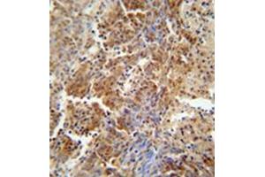 Formalin fixed and paraffin embedded human lung carcinoma reacted with ERCC8 Antibody  followed by peroxidase conjugation of the secondary antibody and DAB staining. (ERCC8 Antikörper  (Middle Region))