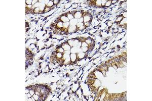 Immunohistochemistry of paraffin-embedded human colon using COX2/PTGS2 Rabbit pAb (ABIN6130125, ABIN6146415, ABIN6146417 and ABIN6216190) at dilution of 1:50 (40x lens). (PTGS2 Antikörper  (AA 375-604))