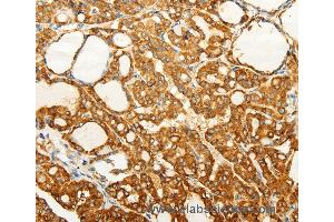 Immunohistochemistry of Human gastric cancer using FZD6 Polyclonal Antibody at dilution of 1:60