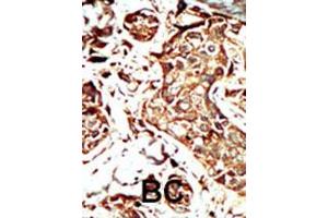 Formalin-fixed and paraffin-embedded human cancer tissue reacted with BRD3 polyclonal antibody  , which was peroxidase-conjugated to the secondary antibody, followed by AEC staining. (BRD3 Antikörper  (C-Term))
