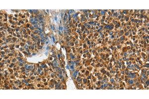 Immunohistochemistry of paraffin-embedded Human liver cancer tissue using ADCY4 Polyclonal Antibody at dilution 1:45