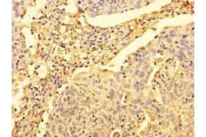 Immunohistochemistry of paraffin-embedded human cervical cancer using ABIN7175093 at dilution of 1:100 (UPRT Antikörper  (AA 1-309))