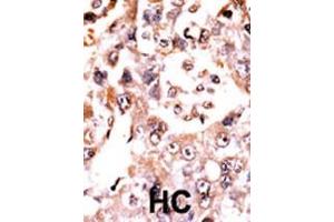 Formalin-fixed and paraffin-embedded human cancer tissue reacted with the primary antibody, which was peroxidase-conjugated to the secondary antibody, followed by AEC staining. (Dual Specificity Phosphatase 3 (DUSP3) (AA 1-30), (N-Term) Antikörper)