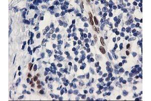 Immunohistochemical staining of paraffin-embedded Adenocarcinoma of Human breast tissue using anti-ELK3 mouse monoclonal antibody. (ELK3 Antikörper)