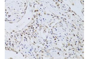 Immunohistochemistry of paraffin-embedded human gastric cancer using FKBP4 Antibody (ABIN5973289) at dilution of 1/100 (40x lens). (FKBP4 Antikörper)