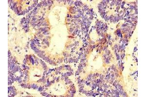 Immunohistochemistry of paraffin-embedded human colon cancer using ABIN7164372 at dilution of 1:100 (DDX6 Antikörper  (AA 1-149))