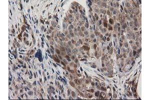 Immunohistochemical staining of paraffin-embedded Adenocarcinoma of Human breast tissue using anti-MAPRE2 mouse monoclonal antibody.