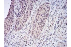Immunohistochemical analysis of paraffin-embedded human cervical cancer tissues using HDAC2 mouse mAb with DAB staining. (HDAC2 Antikörper  (AA 217-327))