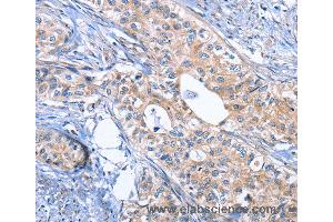 Immunohistochemistry of Human cervical cancer using INHBC Polyclonal Antibody at dilution of 1:50