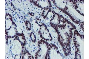 Immunohistochemical staining of paraffin-embedded Adenocarcinoma of Human colon tissue using anti-METT10D mouse monoclonal antibody. (METTL16 Antikörper)