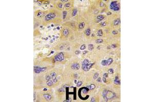 Formalin-fixed and paraffin-embedded human hepatocellular carcinoma reacted with PFKFB1 polyclonal antibody  , which was peroxidase-conjugated to the secondary antibody, followed by DAB staining. (PFKFB1 Antikörper  (N-Term))