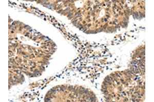The image on the left is immunohistochemistry of paraffin-embedded Human colon cancer tissue using ABIN7192661(SSTR5 Antibody) at dilution 1/30, on the right is treated with synthetic peptide. (SSTR5 Antikörper)