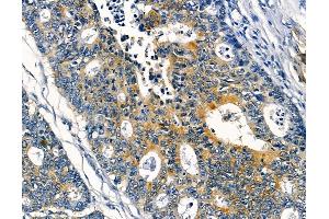ABIN6256861 and ABIN6273953 at 1/100 staining human prostate cancer and adjacent non-tumor tissue by IHC-P. (NPY4R Antikörper  (N-Term))