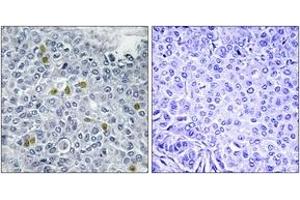 Immunohistochemistry analysis of paraffin-embedded human breast carcinoma, using TOP2A (Phospho-Ser1106) Antibody. (Topoisomerase II alpha Antikörper  (pSer1106))