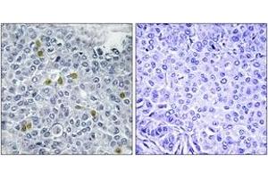 Immunohistochemistry analysis of paraffin-embedded human breast carcinoma, using TOP2A (Phospho-Ser1106) Antibody.