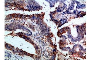 Immunohistochemical analysis of paraffin-embedded human-colon-cancer, antibody was diluted at 1:200 (Integrin alpha 1 Antikörper  (AA 920-980))