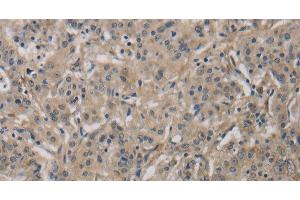 Immunohistochemistry of paraffin-embedded Human gastric cancer tissue using DCN Polyclonal Antibody at dilution 1:30 (Decorin Antikörper)