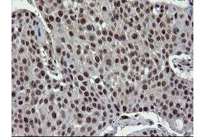 Immunohistochemical staining of paraffin-embedded Carcinoma of Human lung tissue using anti-UBE2E3 mouse monoclonal antibody. (UBE2E3 Antikörper)