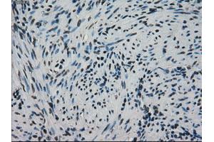 Immunohistochemical staining of paraffin-embedded Adenocarcinoma of ovary tissue using antiHSPA9mouse monoclonal antibody. (HSPA9 Antikörper)
