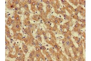 Immunohistochemistry of paraffin-embedded human liver cancer using ABIN7162738 at dilution of 1:100 (GIPC1 Antikörper  (AA 7-74))