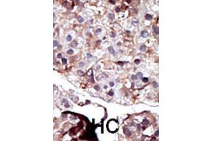 Formalin-fixed and paraffin-embedded human hepatocellular carcinoma tissue reacted with SPHK2 polyclonal antibody  , which was peroxidase-conjugated to the secondary antibody, followed by AEC staining. (SPHK2 Antikörper  (N-Term))