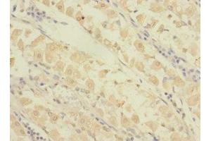 Immunohistochemistry of paraffin-embedded human gastric cancer using ABIN7154384 at dilution of 1:100 (GRAMD1B Antikörper  (AA 235-504))