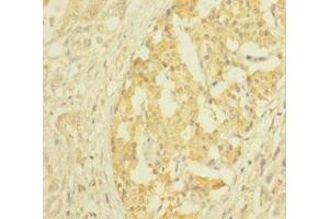 Immunohistochemistry of paraffin-embedded human pancreatic cancer using ABIN7147859 at dilution of 1:100 (CLTB Antikörper  (AA 1-211))