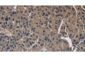 Immunohistochemistry of paraffin-embedded Human liver cancer using SIGMAR1 Polyclonal Antibody at dilution of 1:50 (SIGMAR1 Antikörper)