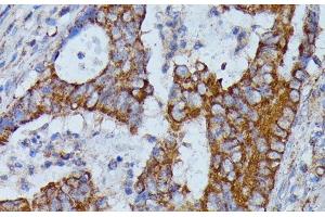 Immunohistochemistry of paraffin-embedded Human colon carcinoma using HMGCS2 Polyclonal Antibody at dilution of 1:100 (40x lens). (HMGCS2 Antikörper)