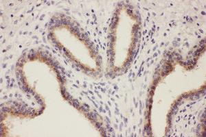 Anti-RTN3 antibody, IHC(P) IHC(P): Human Mammary Cancer Tissue