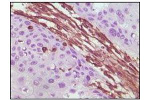 Immunohistochemical analysis of paraffin-embedded human lung carcinoma tissue, showing cytoplasmic localization using Vimentin mouse mAb with DAB staining.