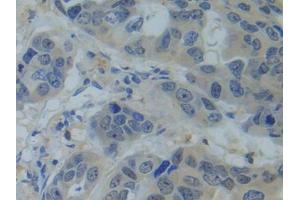 IHC-P analysis of Human Breast cancer Tissue, with DAB staining. (SNRPC Antikörper  (AA 2-159))