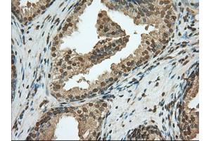Immunohistochemical staining of paraffin-embedded Adenocarcinoma of Human ovary tissue using anti-PDE4A mouse monoclonal antibody. (PDE4A Antikörper)