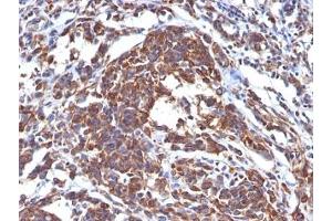 Formalin-fixed, paraffin-embedded human melanoma stained with Vimentin antibody (LN-6).