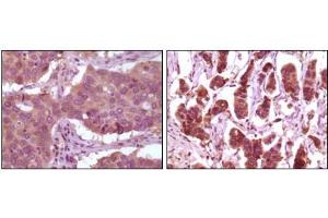 Immunohistochemical analysis of paraffin-embedded human lung carcinoma (left) and breast carcinoma (right) showing cytoplasmic localization using ERK2 mouse mAb with DAB staining. (ERK2 Antikörper)