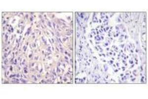 Immunohistochemistry analysis of paraffin-embedded human breast carcinoma tissue using UBE1L antibody. (UBA7 Antikörper  (C-Term))